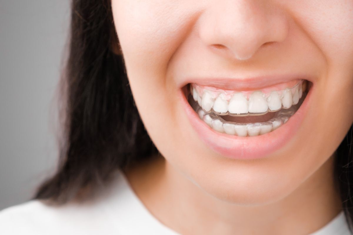 Common Invisalign Mistakes That Delay Results