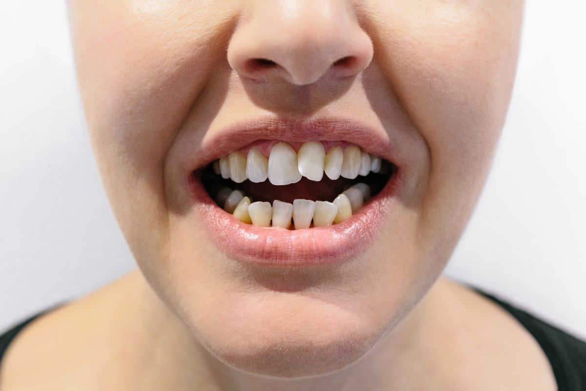 Close-up showing crowded and misaligned teeth that may be treated with clear aligners